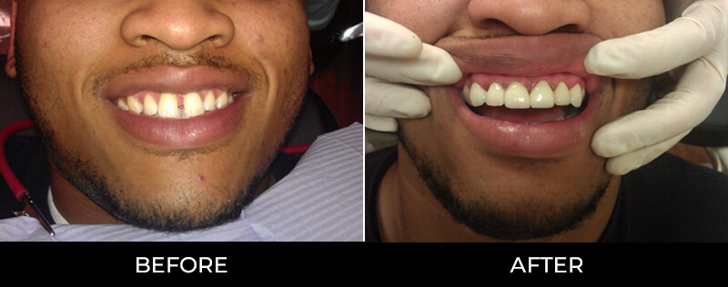 Before/After